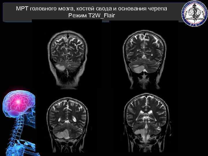 МРТ головного мозга, костей свода и основания черепа Режим T 2 W_Flair 