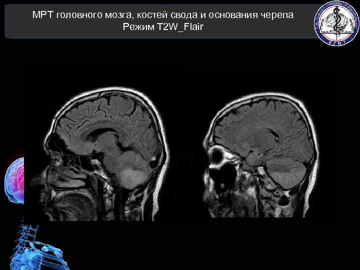 МРТ головного мозга, костей свода и основания черепа Режим T 2 W_Flair 