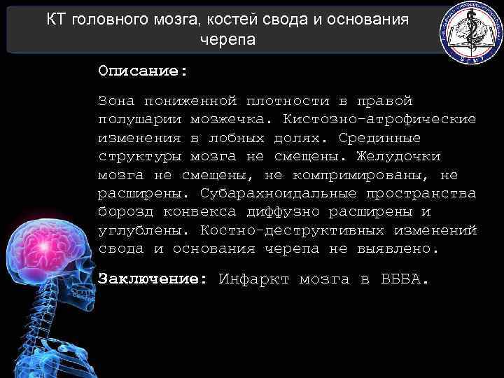 КТ головного мозга, костей свода и основания черепа Описание: Зона пониженной плотности в правой