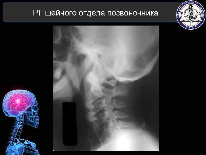 РГ шейного отдела позвоночника 