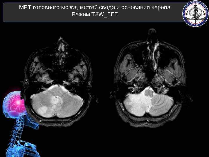 МРТ головного мозга, костей свода и основания черепа Режим T 2 W_FFE 