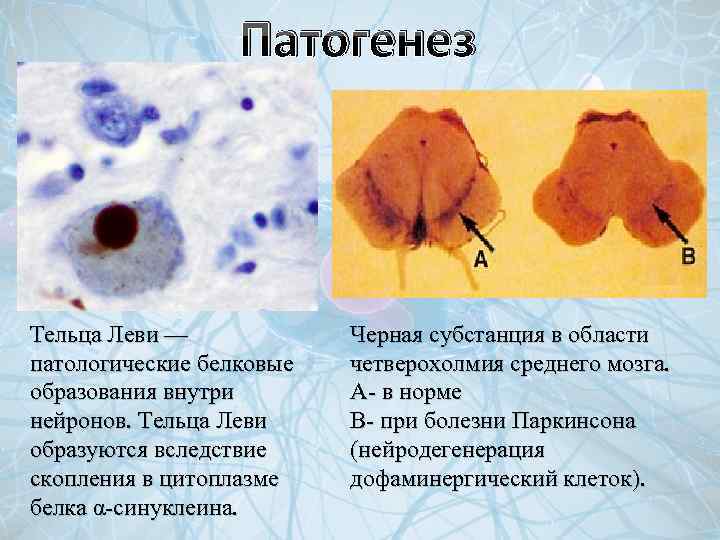 Патогенез Тельца Леви — патологические белковые образования внутри нейронов. Тельца Леви образуются вследствие скопления