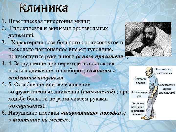 Клиника 1. Пластическая гипертония мышц 2. Гипокинезия и акинезия произвольных движений. 3. Характерная поза