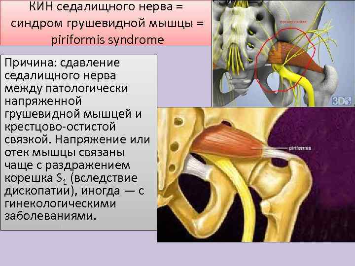 КИН седалищного нерва = синдром грушевидной мышцы = piriformis syndrome Причина: сдавление седалищного нерва