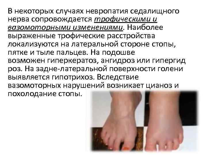 В некоторых случаях невропатия седалищного нерва сопровождается трофическими и вазомоторными изменениями. Наиболее выраженные трофические