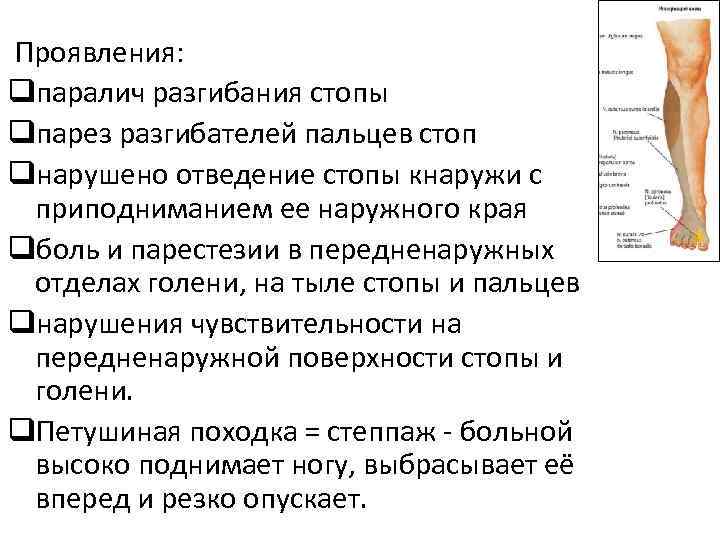  Проявления: qпаралич разгибания стопы qпарез разгибателей пальцев стоп qнарушено отведение стопы кнаружи с