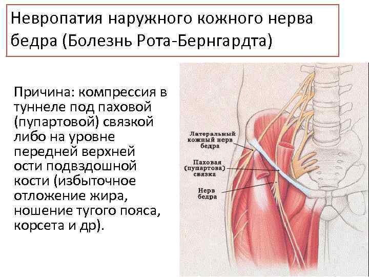 Невропатия наружного кожного нерва бедра (Болезнь Рота-Бернгардта) Причина: компрессия в туннеле под паховой (пупартовой)