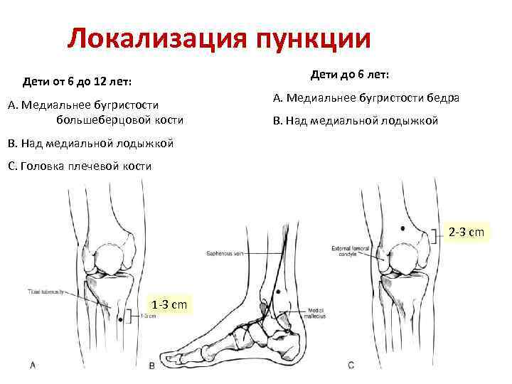 Локализация пункции Дети до 6 лет: Дети от 6 до 12 лет: A. Медиальнее