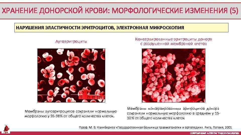 ХРАНЕНИЕ ДОНОРСКОЙ КРОВИ: МОРФОЛОГИЧЕСКИЕ ИЗМЕНЕНИЯ (5) НАРУШЕНИЯ ЭЛАСТИЧНОСТИ ЭРИТРОЦИТОВ, ЭЛЕКТРОННАЯ МИКРОСКОПИЯ Аутоэритроциты Консервированные эритроциты