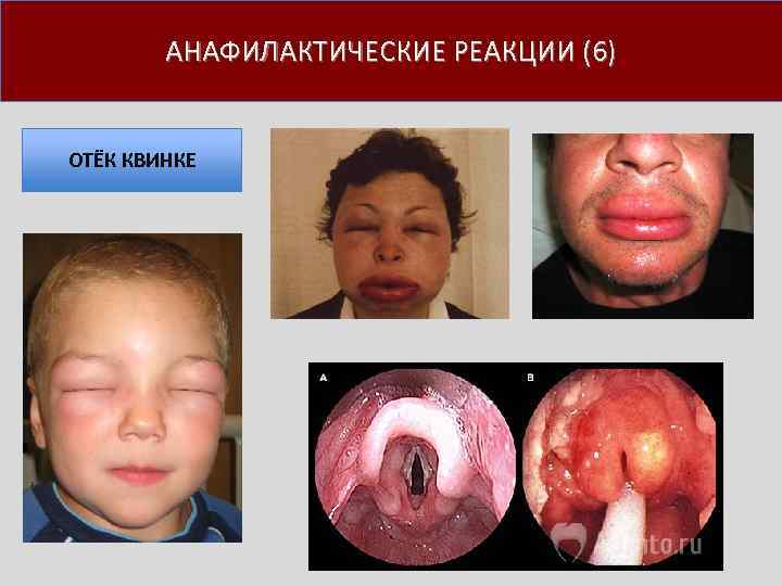 АНАФИЛАКТИЧЕСКИЕ РЕАКЦИИ (6) ОТЁК КВИНКЕ 