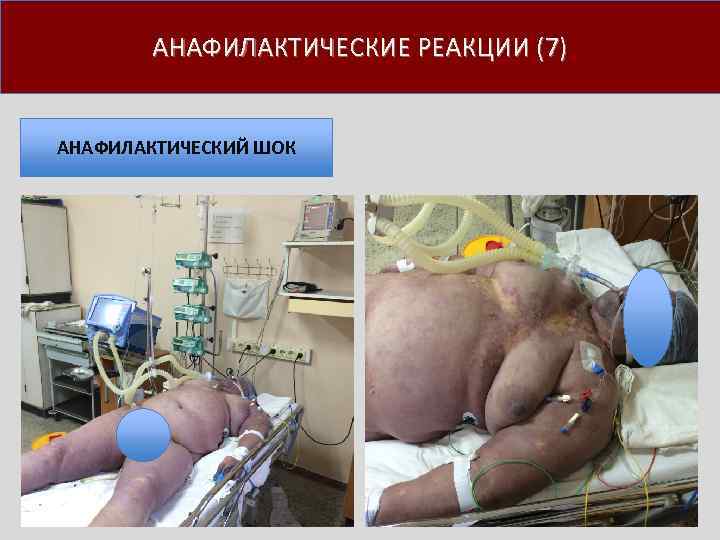 АНАФИЛАКТИЧЕСКИЕ РЕАКЦИИ (7) АНАФИЛАКТИЧЕСКИЙ ШОК 
