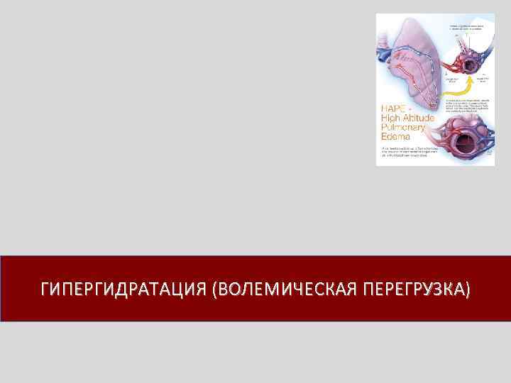 ГИПЕРГИДРАТАЦИЯ (ВОЛЕМИЧЕСКАЯ ПЕРЕГРУЗКА) 