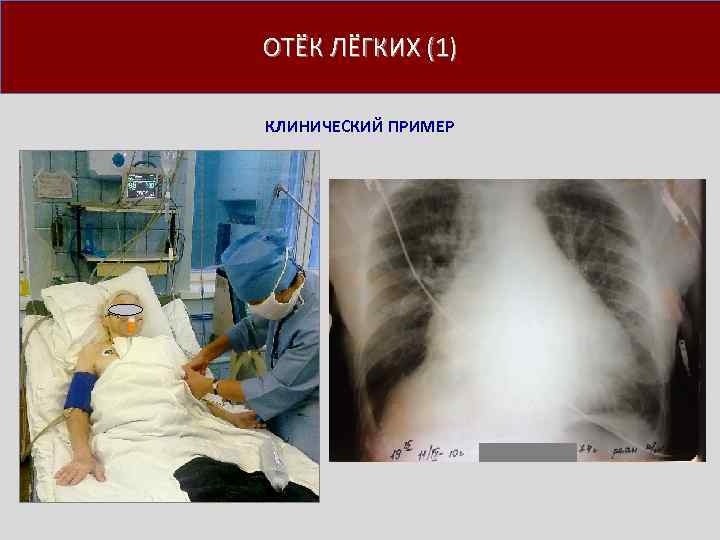 ОТЁК ЛЁГКИХ (1) КЛИНИЧЕСКИЙ ПРИМЕР 