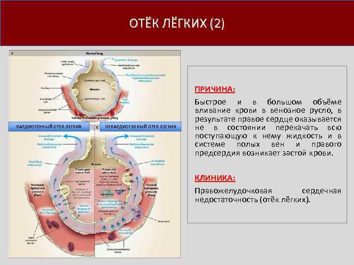 ОТЁК ЛЁГКИХ (2) КАРДИОГЕННЫЙ ОТЕК ЛЕГКИХ НЕКАРДИОГЕННЫЙ ОТЕК ЛЕГКИХ ПРИЧИНА: Быстрое и в большом