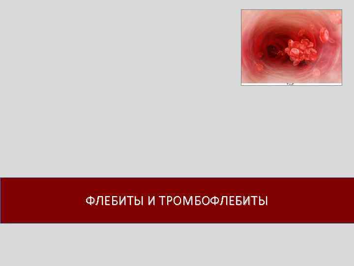 ФЛЕБИТЫ И ТРОМБОФЛЕБИТЫ 