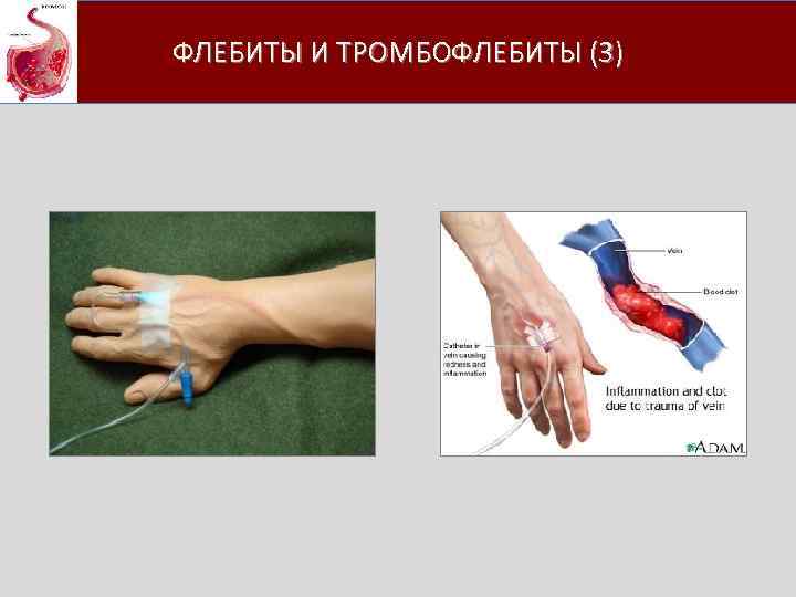 ФЛЕБИТЫ И ТРОМБОФЛЕБИТЫ (3) 