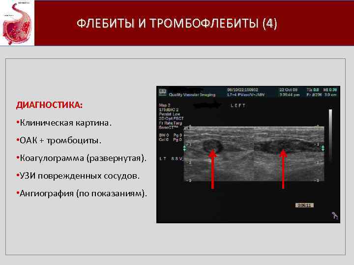 ФЛЕБИТЫ И ТРОМБОФЛЕБИТЫ (4) ДИАГНОСТИКА: • Клиническая картина. • ОАК + тромбоциты. • Коагулограмма