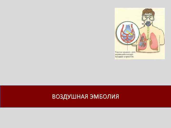 ВОЗДУШНАЯ ЭМБОЛИЯ 