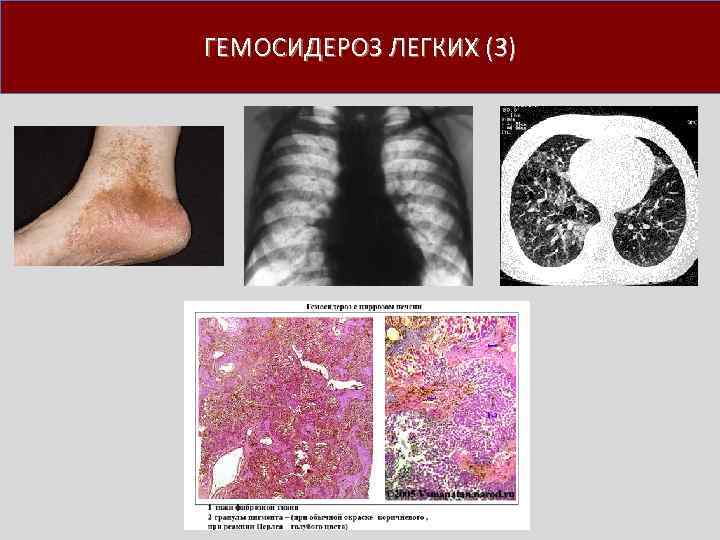ГЕМОСИДЕРОЗ ЛЕГКИХ (3) 