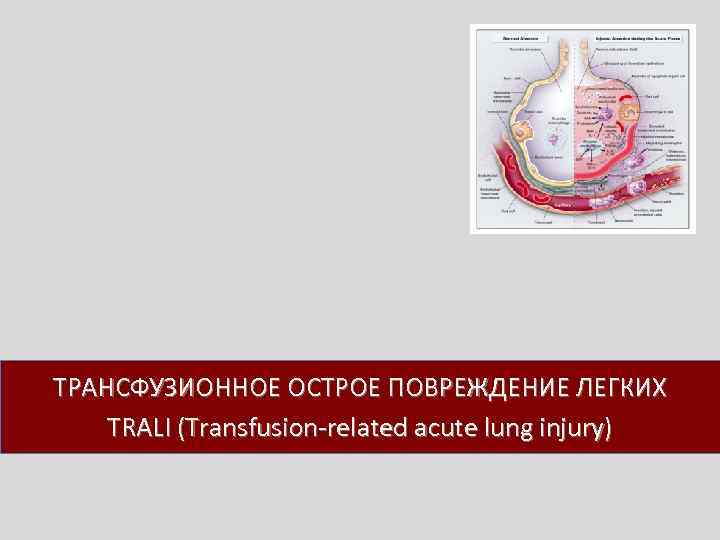 ТРАНСФУЗИОННОЕ ОСТРОЕ ПОВРЕЖДЕНИЕ ЛЕГКИХ TRALI (Transfusion related acute lung injury) 