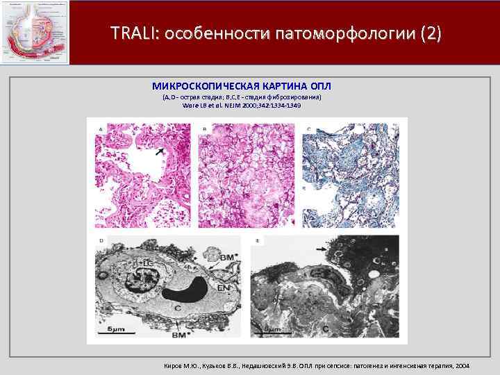 Микроскопическая картина. Эндокардит микроскопическая картина. Некротическая стадия микроскопическая картина. Гестоз микроскопическая картина. Какова микроскопическая картина при стеаторее.