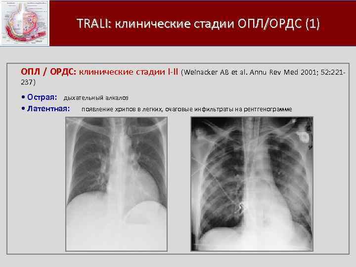 Уплотнение легкого при ордс связано