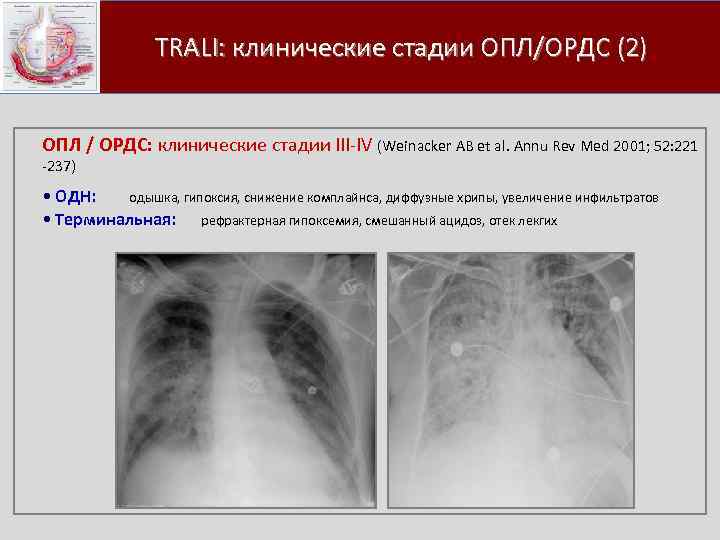  TRALI: клинические стадии ОПЛ/ОРДС (2) ОПЛ / ОРДС: клинические стадии III IV (Weinacker