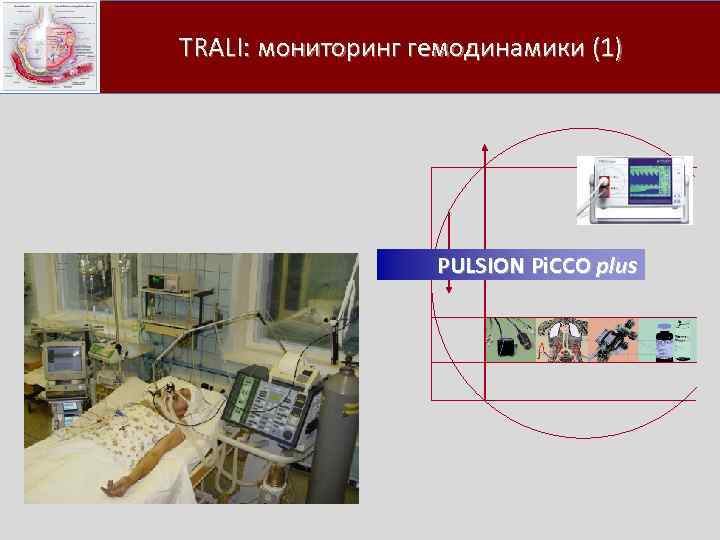  TRALI: мониторинг гемодинамики (1) PULSION Pi. CCO plus 