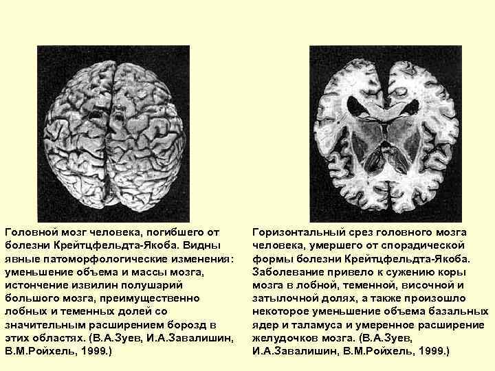 Головной мозг человека, погибшего от болезни Крейтцфельдта-Якоба. Видны явные патоморфологические изменения: уменьшение объема и