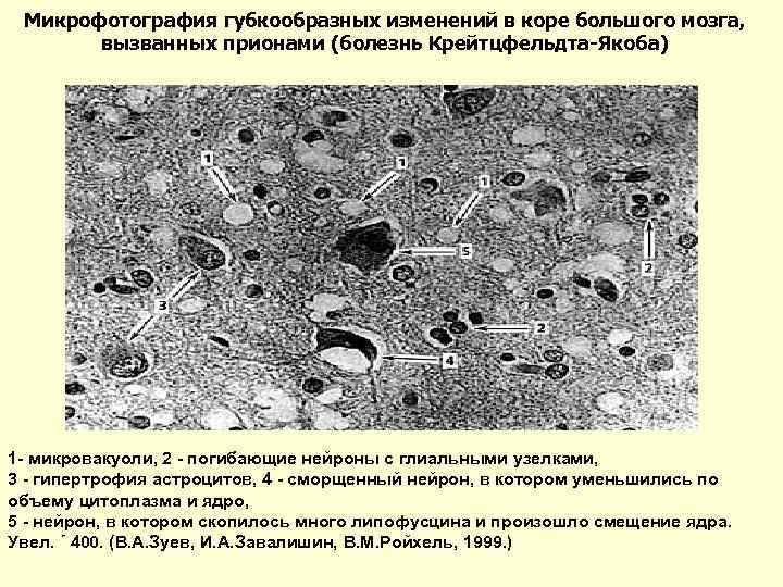 Микрофотография губкообразных изменений в коре большого мозга, вызванных прионами (болезнь Крейтцфельдта-Якоба) 1 - микровакуоли,