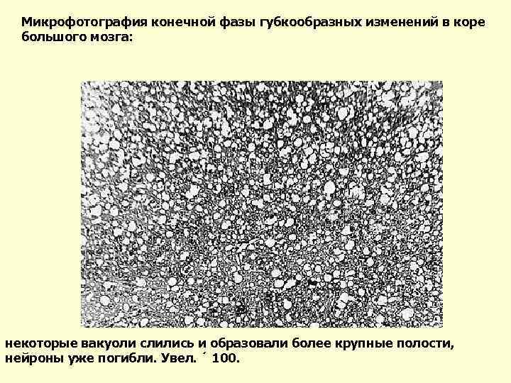 Микрофотография конечной фазы губкообразных изменений в коре большого мозга: некоторые вакуоли слились и образовали