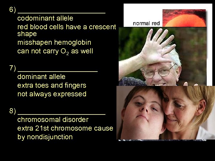 6) ___________ codominant allele red blood cells have a crescent shape misshapen hemoglobin can
