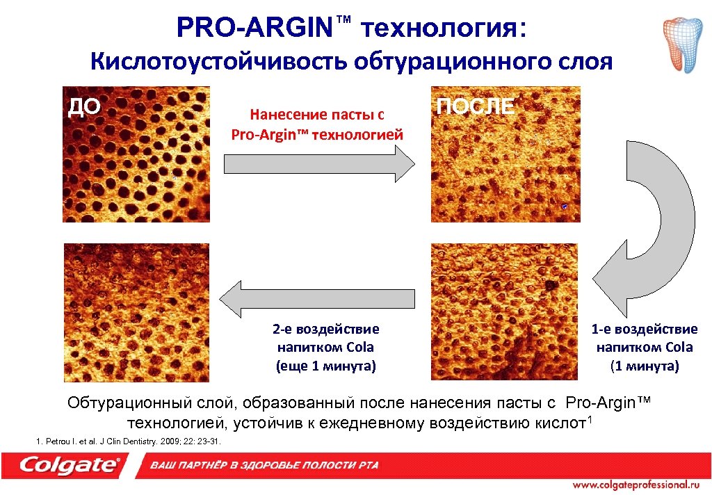 PRO-ARGIN™ технология: Кислотоустойчивость обтурационного слоя ДО Нанесение пасты с Pro-Argin™ технологией 2 -е воздействие