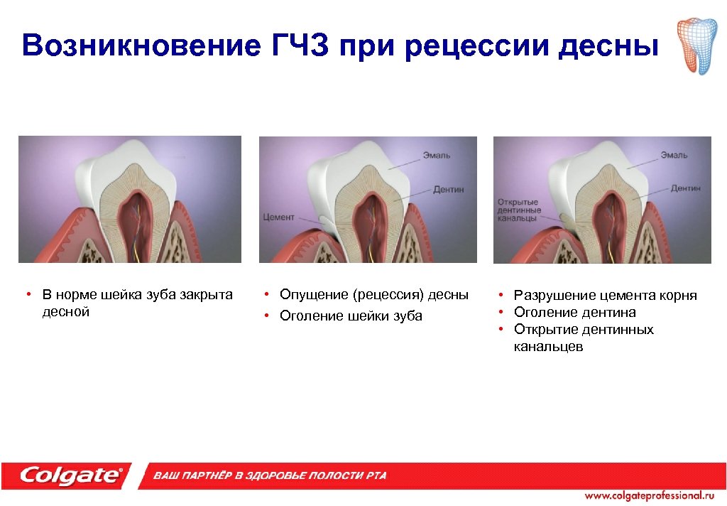 Возникновение ГЧЗ при рецессии десны • В норме шейка зуба закрыта десной • Опущение