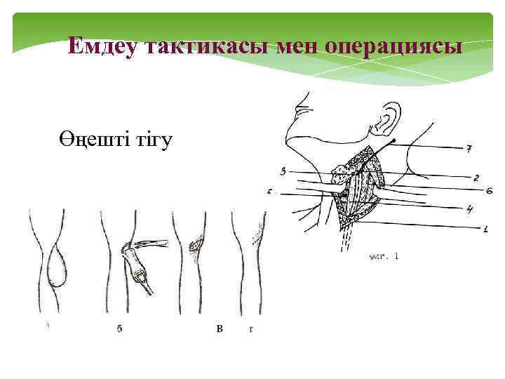 Емдеу тактикасы мен операциясы Өңешті тігу 