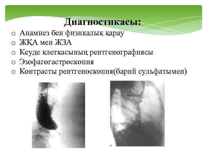 Диагностикасы: o o o Анамнез бен физикалық қарау ЖҚА мен ЖЗА Кеуде клеткасының рентгенографиясы