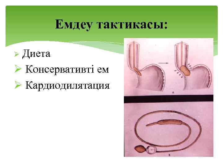 Емдеу тактикасы: Диета Ø Консервативті ем Ø Кардиодилятация Ø 