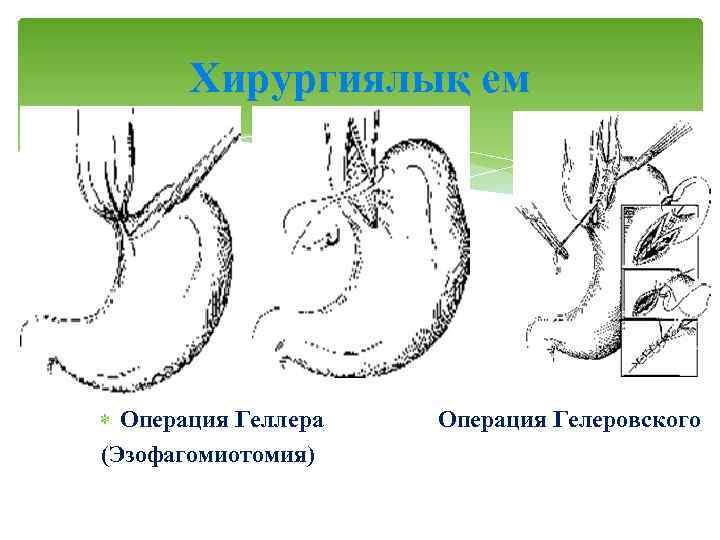 Хирургиялық ем Операция Геллера (Эзофагомиотомия) Операция Гелеровского 