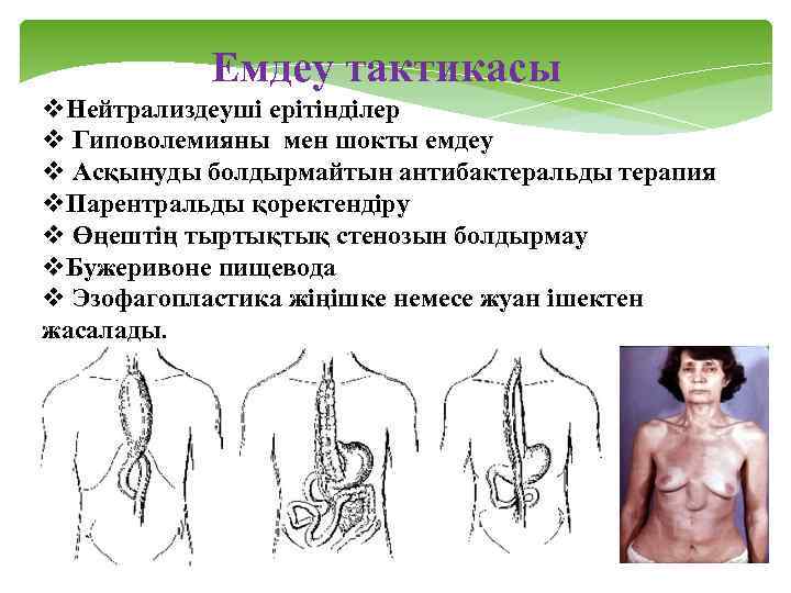 Емдеу тактикасы v. Нейтрализдеуші ерітінділер v Гиповолемияны мен шокты емдеу v Асқынуды болдырмайтын антибактеральды