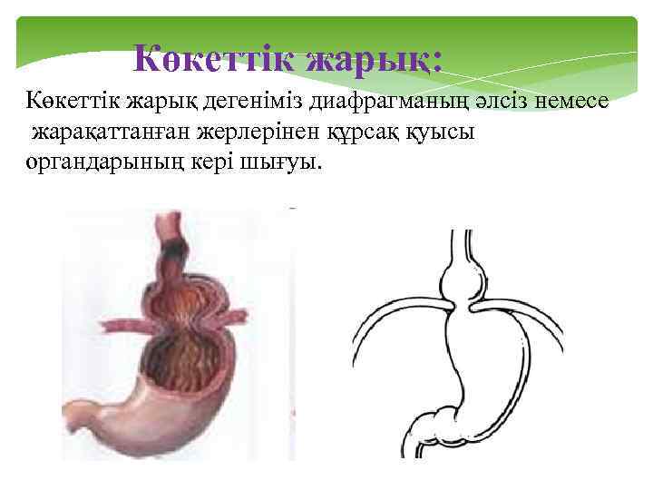 Көкеттік жарық: Көкеттік жарық дегеніміз диафрагманың әлсіз немесе жарақаттанған жерлерінен құрсақ қуысы органдарының кері