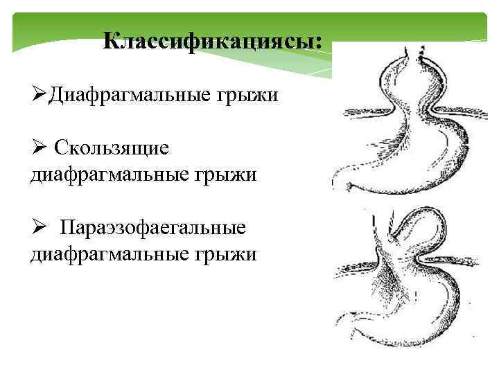 Классификациясы: ØДиафрагмальные грыжи Ø Скользящие диафрагмальные грыжи Ø Параэзофаегальные диафрагмальные грыжи 