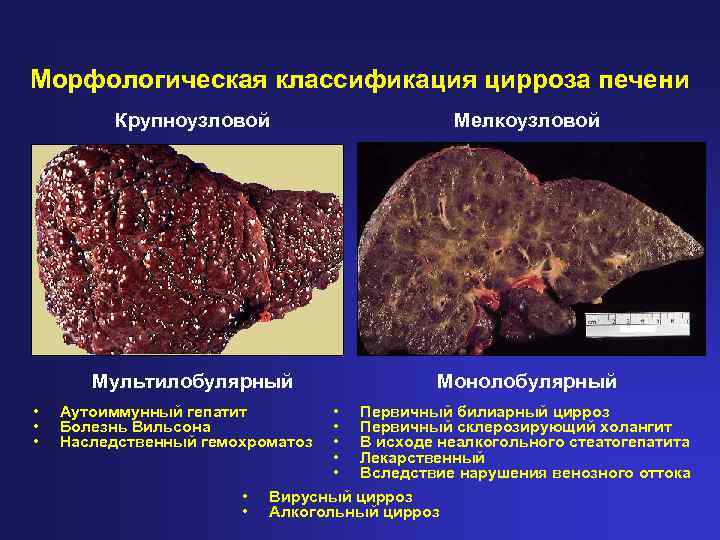 Морфологическая классификация цирроза печени Крупноузловой Мультилобулярный • • • Мелкоузловой Монолобулярный • Первичный билиарный