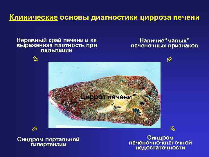 Клинические основы диагностики цирроза печени Неровный край печени и ее выраженная плотность при пальпации