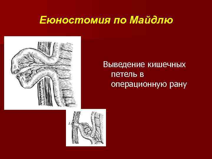 Еюностомия по Майдлю Выведение кишечных петель в операционную рану 