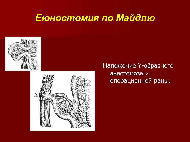 Еюностомия по Майдлю Наложение Y-образного анастомоза и операционной раны. 