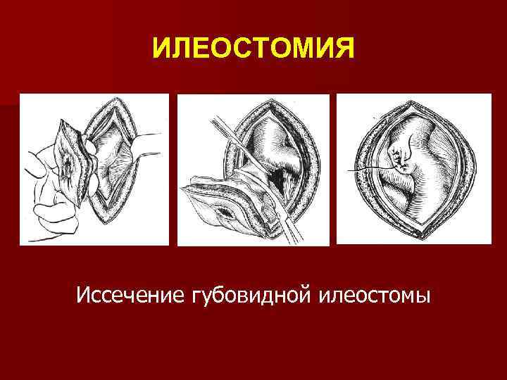 ИЛЕОСТОМИЯ Иссечение губовидной илеостомы 