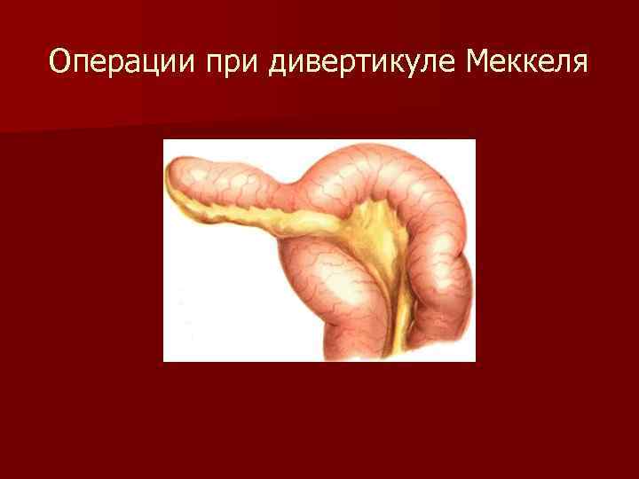 Операции при дивертикуле Меккеля 
