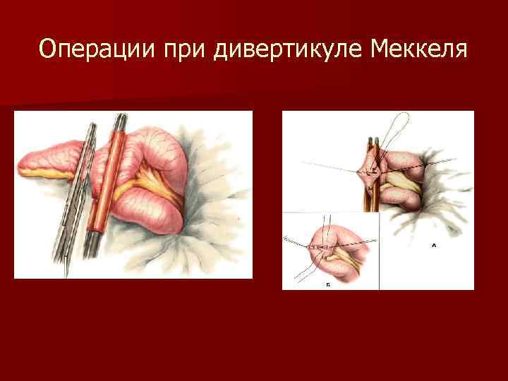 Операции при дивертикуле Меккеля 