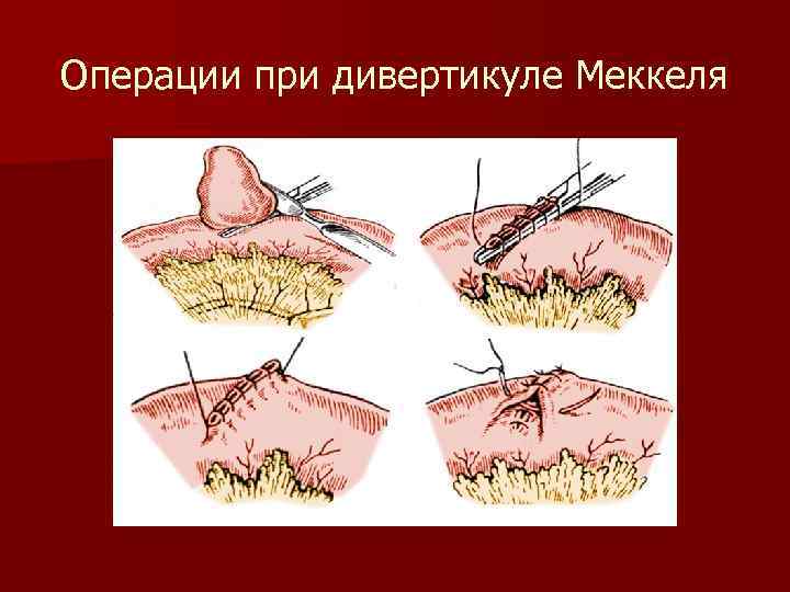Операции при дивертикуле Меккеля 