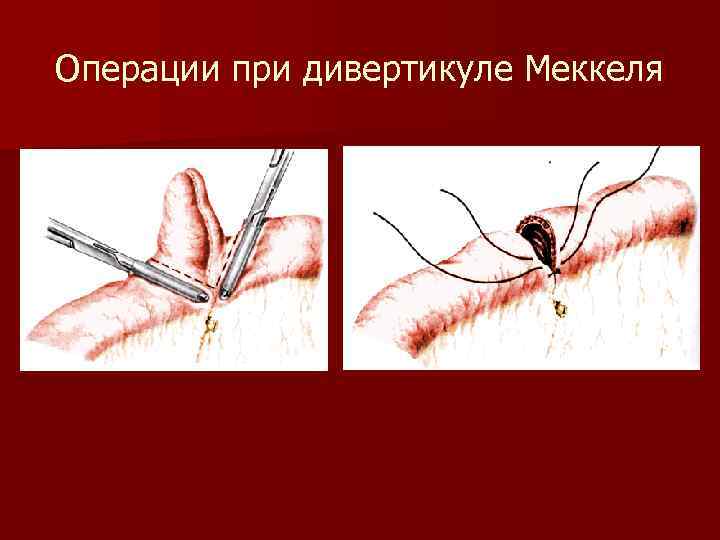 Операции при дивертикуле Меккеля 